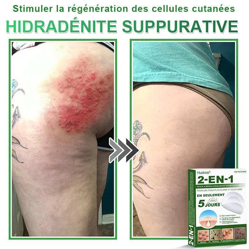 👉80% DE RÉDUCTION 🔥Hudros® Patch 2-en-1 à Micro-Aiguilles & Hydrocolloïde | Aide à Réduire l’Apparence de l’Acné, des Verrues Plates et des Acrochordons | Patchs Invisibles pour le Visage et le Corps | 144 Pièces 🔥