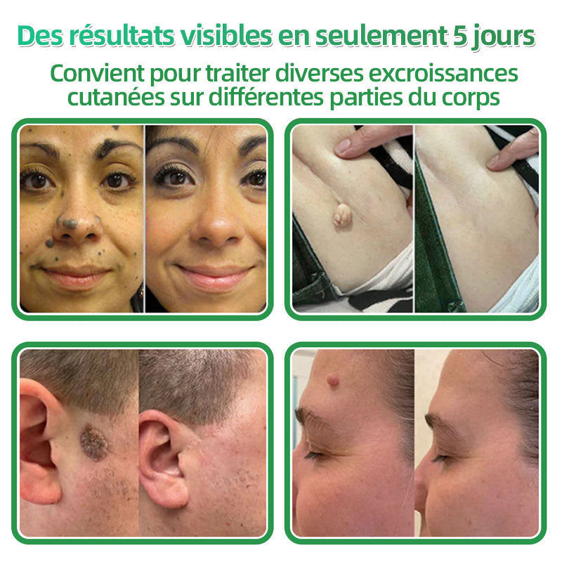 👉80% DE RÉDUCTION 🔥Hudros® Patch 2-en-1 à Micro-Aiguilles & Hydrocolloïde | Aide à Réduire l’Apparence de l’Acné, des Verrues Plates et des Acrochordons | Patchs Invisibles pour le Visage et le Corps | 144 Pièces 🔥