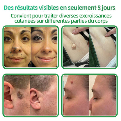 👉80% DE RÉDUCTION 🔥Hudros® Patch 2-en-1 à Micro-Aiguilles & Hydrocolloïde | Aide à Réduire l’Apparence de l’Acné, des Verrues Plates et des Acrochordons | Patchs Invisibles pour le Visage et le Corps | 144 Pièces 🔥
