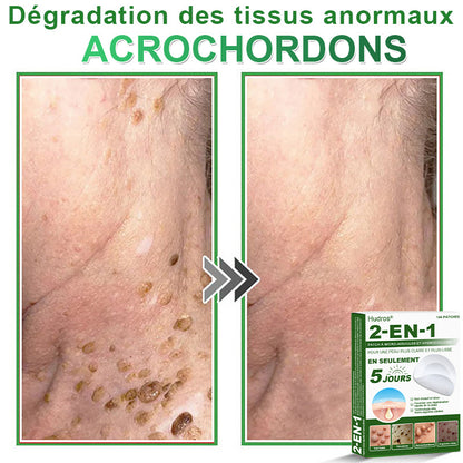 👉80% DE RÉDUCTION 🔥Hudros® Patch 2-en-1 à Micro-Aiguilles & Hydrocolloïde | Aide à Réduire l’Apparence de l’Acné, des Verrues Plates et des Acrochordons | Patchs Invisibles pour le Visage et le Corps | 144 Pièces 🔥