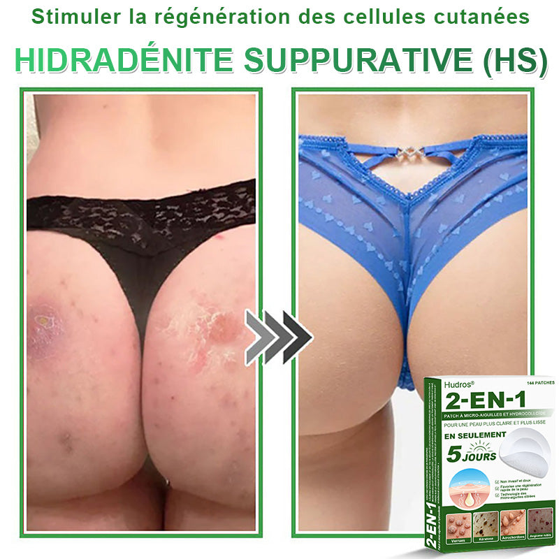 👉80% DE RÉDUCTION 🔥Hudros® Patch 2-en-1 à Micro-Aiguilles & Hydrocolloïde | Aide à Réduire l’Apparence de l’Acné, des Verrues Plates et des Acrochordons | Patchs Invisibles pour le Visage et le Corps | 144 Pièces 🔥