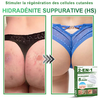 👉80% DE RÉDUCTION 🔥Hudros® Patch 2-en-1 à Micro-Aiguilles & Hydrocolloïde | Aide à Réduire l’Apparence de l’Acné, des Verrues Plates et des Acrochordons | Patchs Invisibles pour le Visage et le Corps | 144 Pièces 🔥