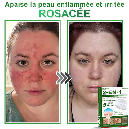 👉80% DE RÉDUCTION 🔥Hudros® Patch 2-en-1 à Micro-Aiguilles & Hydrocolloïde | Aide à Réduire l’Apparence de l’Acné, des Verrues Plates et des Acrochordons | Patchs Invisibles pour le Visage et le Corps | 144 Pièces 🔥