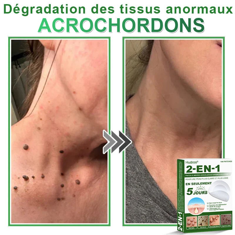 👉80% DE RÉDUCTION 🔥Hudros® Patch 2-en-1 à Micro-Aiguilles & Hydrocolloïde | Aide à Réduire l’Apparence de l’Acné, des Verrues Plates et des Acrochordons | Patchs Invisibles pour le Visage et le Corps | 144 Pièces 🔥