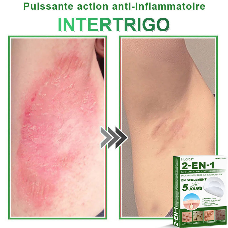👉80% DE RÉDUCTION 🔥Hudros® Patch 2-en-1 à Micro-Aiguilles & Hydrocolloïde | Aide à Réduire l’Apparence de l’Acné, des Verrues Plates et des Acrochordons | Patchs Invisibles pour le Visage et le Corps | 144 Pièces 🔥