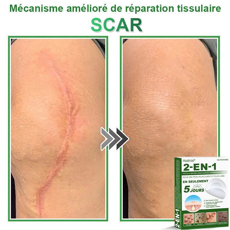 👉80% DE RÉDUCTION 🔥Hudros® Patch 2-en-1 à Micro-Aiguilles & Hydrocolloïde | Aide à Réduire l’Apparence de l’Acné, des Verrues Plates et des Acrochordons | Patchs Invisibles pour le Visage et le Corps | 144 Pièces 🔥
