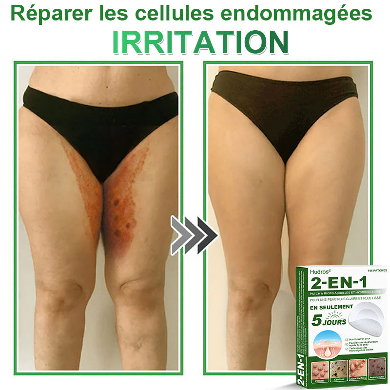 👉80% DE RÉDUCTION 🔥Hudros® Patch 2-en-1 à Micro-Aiguilles & Hydrocolloïde | Aide à Réduire l’Apparence de l’Acné, des Verrues Plates et des Acrochordons | Patchs Invisibles pour le Visage et le Corps | 144 Pièces 🔥